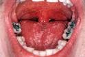 thrush infection: How to Treat Thrush?