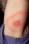 Lyme disease - Wikipedia, the free encyclopedia