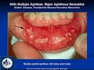 <b>Stomatitis</b>