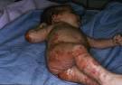 Epidermolysis Bullosa.