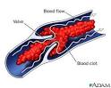 Venous blood clot: MedlinePlus Medical Encyclopedia Image