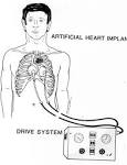 File:Jarvik-7 Artificial Heart Image 3559-OT.jpg - Wikipedia, the ...