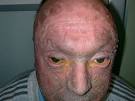 Lamellar <b>ichthyosis</b> is a rare