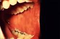 Detecting Oral Cancer: A Guide for Health Care Professionals