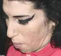 15 Celebrities With Bad Skin