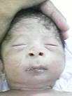 <b>Smith</b>-<b>Lemli</b>-<b>Opitz syndrome</b> -