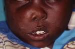 Craniofacial fibrous dysplasia