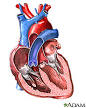 Heart Surgery: MedlinePlus