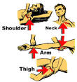 Simple Survival - Stop Bleeding