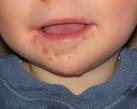 Hand Foot and Mouth Disease Pictures, Symptoms, Causes and Treatment