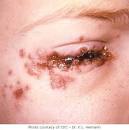 Herpes Pictures - Herpes Pictures and Cold Sores Pictures