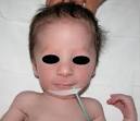 Prader Willi syndrome