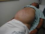 Draping the <b>Abdomen</b>