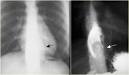 <b>Esophageal</b> leiomyoma