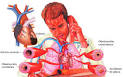 <b>Infarto</b> de <b>miocardio</b>