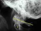 Atlanto-axial Impaction (Basilar Invagination) - Wheeless ...