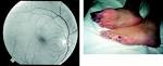(Atheroembolism; <b><b>Cholesterol Embolism</b></b>)