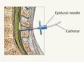 Epidural Steroid Injection | Life in Pain