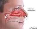Runny and stuffy nose: MedlinePlus Medical Encyclopedia Image