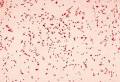 Acinetobacter Baumannii in Iraq