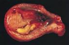 File:<b>Endometrial stromal</b>