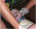 <b>Nuchal cords</b> are rarely found