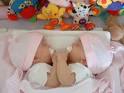 formerly conjoined twins,