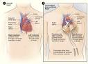 What Is a Total Artificial Heart? - NHLBI, NIH