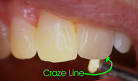 Restoration of <b>fractured teeth</b>