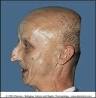 Werner Syndrome: