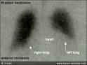 The PULMONARY EMBOLISM - How to make the PULMONARY EMBOLISM diagnosis?