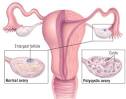 Polycystic <b>Ovary</b> Syndrome