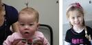 of Stickler syndrome with