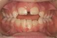 orthodontie précoce <b>béance</b>