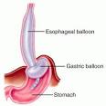 cardiac tamponade - definition of cardiac tamponade in the Medical ...