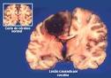 What does Brain Hemorrhage look like? Are you also searching for ...