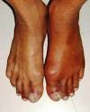 Gout symptoms