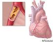 blockage (<b>atherosclerosis</b>)