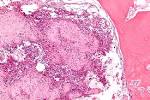 File:<b>Chondroblastoma</b>