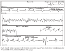Arquivos Brasileiros de Cardiologia - Use of automated external ...