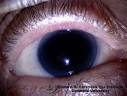 Glaucoma-<b>Aniridia</b>