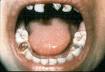 Preventing cavities using natural methods