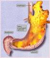 Acid Reflux « Hats Snap Backs Health Issues