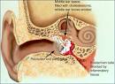 Chronic Ear Infections (Otitis Media)