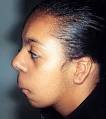 (<b>Langer</b>-<b>Giedion Syndrome</b>)
