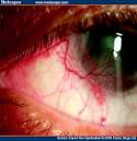 <b>Conjunctival</b> squamous cell