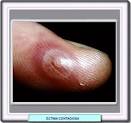 El <b>ectima</b> contagioso también