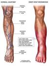 Deep Vein <b>Thrombosis</b>
