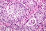 File:<b>Adenosquamous carcinoma</b>