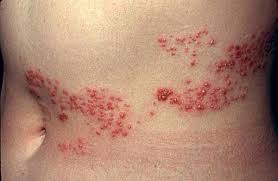 shingles virus